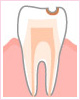 2．歯の表面の虫歯