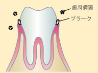 2．軽度歯周病