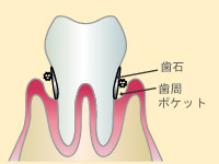 3．中程度歯周病